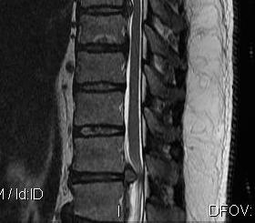 Thoracic Herniate Disc Sagittal